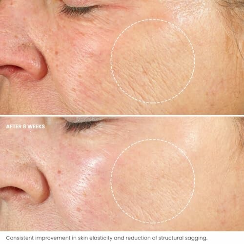 Comparison of skin elasticity improvement after 8-week treatment.